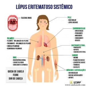 lupus-pag